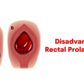 Disadvantages of Rectal Prolapse Surgery