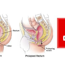 How Risky is Rectal Prolapse Surgery