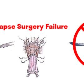 Rectal Prolapse Surgery Failure