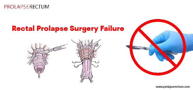 Rectal Prolapse Surgery Failure Rectal Prolapse Surgery Failure