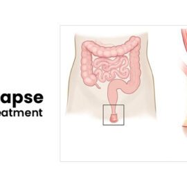 Rectal Prolapse Non-Surgical Treatment Rectal Prolapse Non-Surgical Treatment