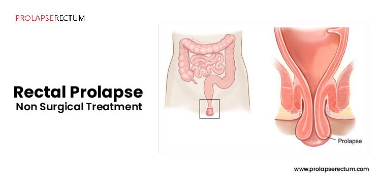 Rectal Prolapse Non-Surgical Treatment Rectal Prolapse Non-Surgical Treatment