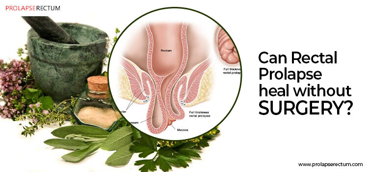Can Rectal Prolapse Heal Without Surgery? Can Rectal Prolapse Heal Without Surgery