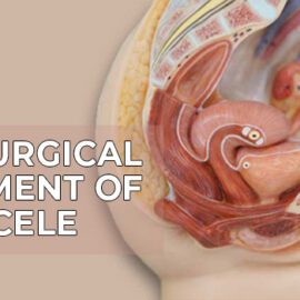 Non-Surgical Treatment of Rectocele? Non-Surgical Treatment of Rectocele