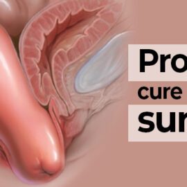prolapse cure without surgery