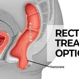 Rectocele Treatment Options