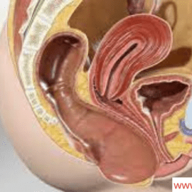 Rectocele Repair Procedure Without Surgery