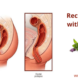 Rectocele Repair Without Surgery