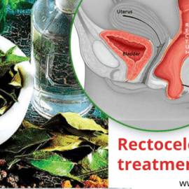 Rectocele Treatment In India