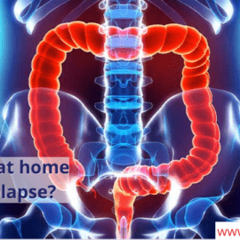 rectocele repair procedure without surgery