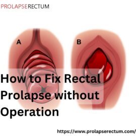How To Fix Rectal Prolapse