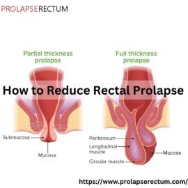 How to Reduce Rectal Prolapse