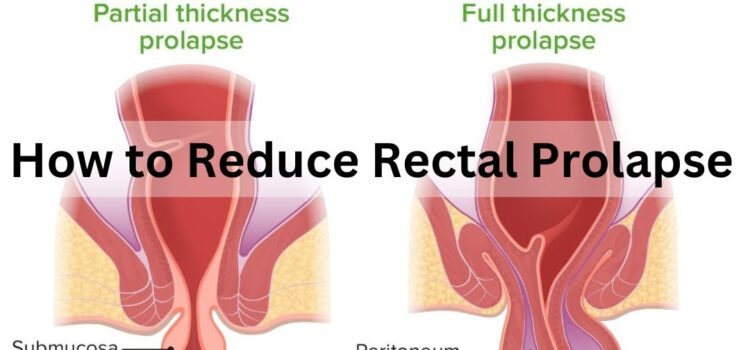 How to Reduce Rectal Prolapse