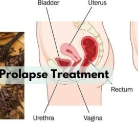 Natural Rеmеdiеs for Rеctal Prolapsе Trеatmеnt without Surgеry