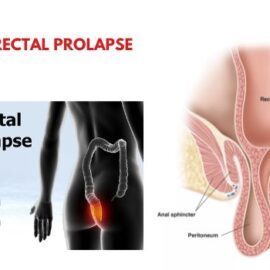 Precautions for Rectal Prolapse Patients