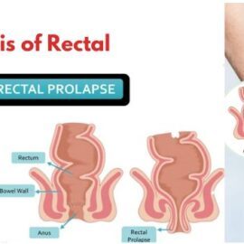 Herbs for Rectal Prolapse Treatment