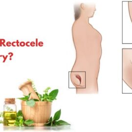 Can You Treat Rectocele Without Surgery?