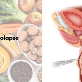 Diet for Rectal Prolapse