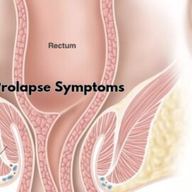 Internal Rectal Prolapse Symptoms