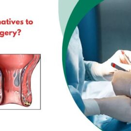 What Are the Alternatives to Rectal Prolapse Surgery?