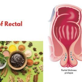Management of Rectal Prolapse