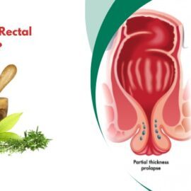 How Can I Reverse Rectal Prolapse Naturally?