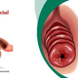 Herbal Cure of Rectal Prolapse