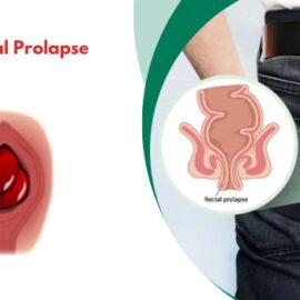Can I Push My Rectal Prolapse Back Up?