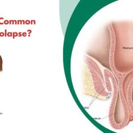 What Is the Most Common Cause of Rectal Prolapse?