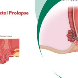 What Happens if Rectal Prolapse Is Left Untreated?