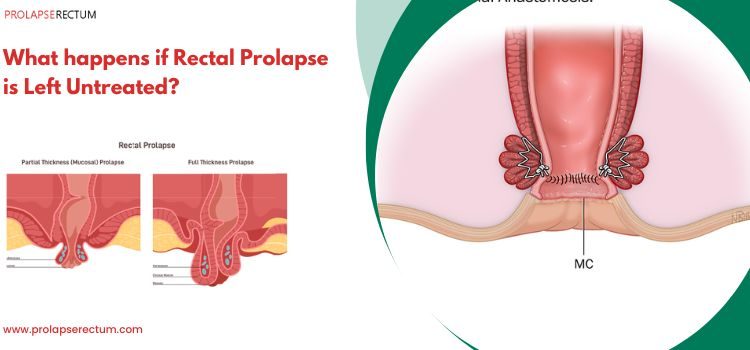 What Happens if Rectal Prolapse Is Left Untreated? What Happens if Rectal Prolapse Is Left Untreated?