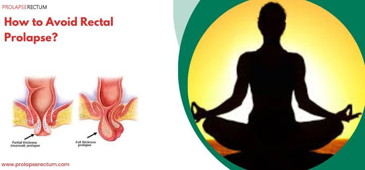 How to Avoid Rectal Prolapse? How to Avoid Rectal Prolapse?