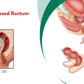 Symptoms of Prolapsed Rectum in the Elderly