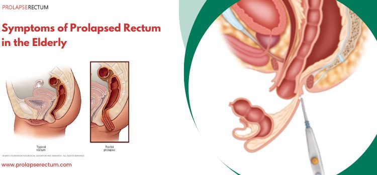 Symptoms of Prolapsed Rectum in the Elderly Symptoms of Prolapsed Rectum in the Elderly