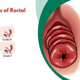 How Many Stages of Rectal Prolapse? How Many Stages of Rectal Prolapse?
