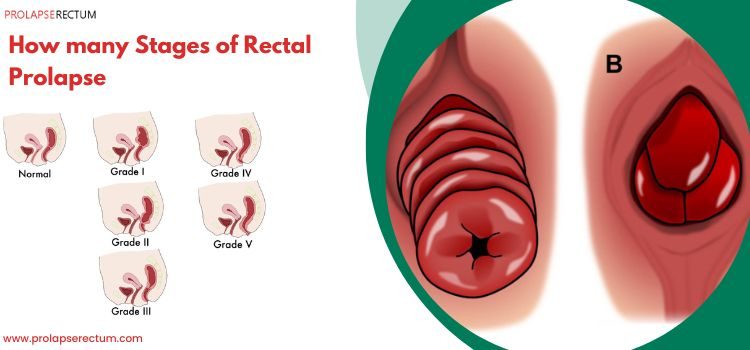 How Many Stages of Rectal Prolapse? How Many Stages of Rectal Prolapse?