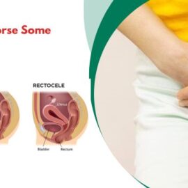 Why Is Prolapse Worse Some Days?