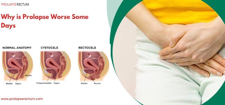 Why Is Prolapse Worse Some Days? Why Is Prolapse Worse Some Days?