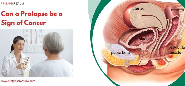 Can a Prolapse Be a Sign of Cancer? Can a Prolapse Be a Sign of Cancer?