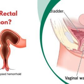 At What Age is Rectal Prolapse Common? At What Age is Rectal Prolapse Common?