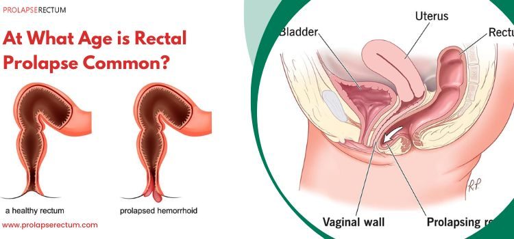 At What Age is Rectal Prolapse Common?