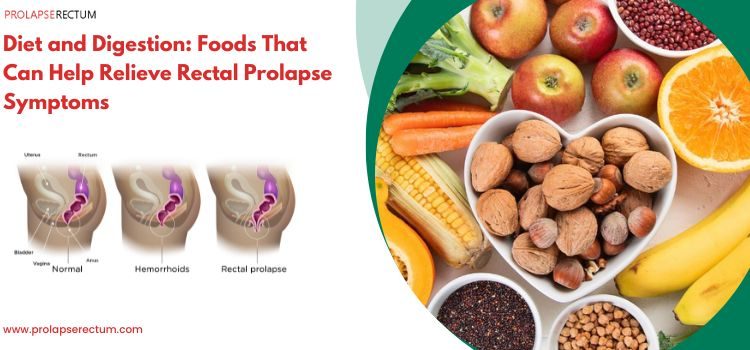 Diet and Digestion: Foods That Can Help Relieve Rectal Prolapse Symptoms Diet and Digestion: Foods That Can Help Relieve Rectal Prolapse Symptoms