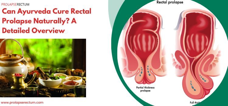 Can Ayurveda Cure Rectal Prolapse Naturally? A Detailed Overview Can Ayurveda Cure Rectal Prolapse Naturally? A Detailed Overview