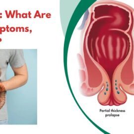 Rectal Prolapse: What Are Its Causes, Symptoms, and Treatment?