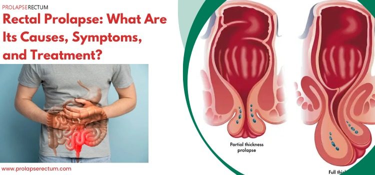 Rectal Prolapse: What Are Its Causes, Symptoms, and Treatment? Rectal Prolapse: What Are Its Causes, Symptoms, and Treatment?