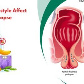How Stress and Lifestyle Affect Gut Health and Prolapse?