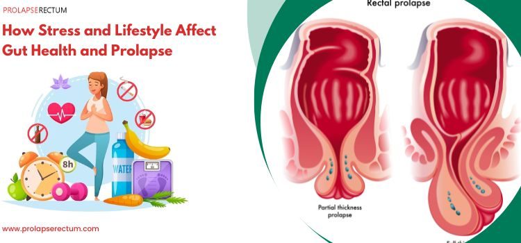 How Stress and Lifestyle Affect Gut Health and Prolapse?