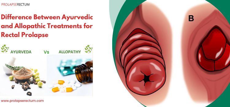 Difference Between Ayurvedic and Allopathic Treatments for Rectal Prolapse