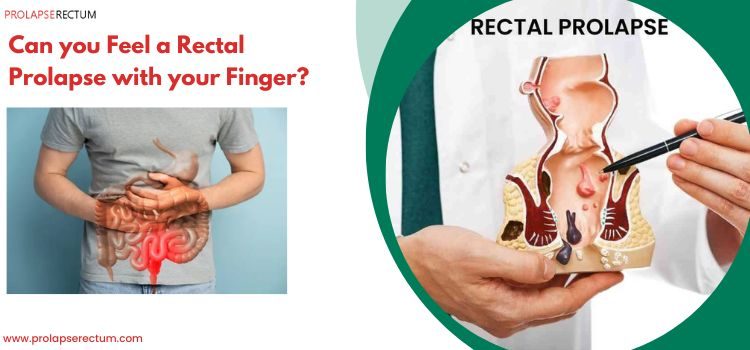 Can You Feel A Prolapse Rectum With Your Finger? Can You Feel A Prolapse Rectum With Your Finger?