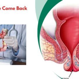 Can Rectal Prolapse Come Back After Surgery?